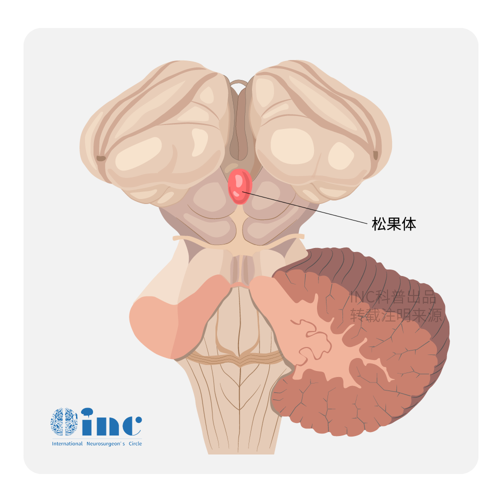 儿童松果体区肿瘤临床表现有哪