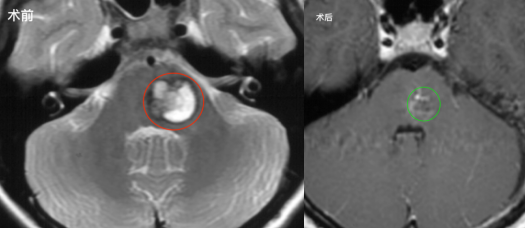 脑干海绵状血管瘤保守治疗