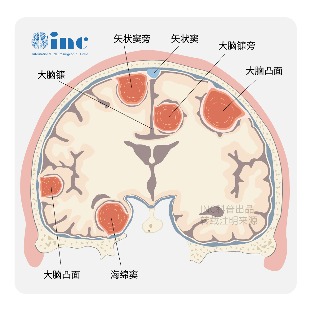 各级别脑膜瘤怎么治疗？脑膜瘤