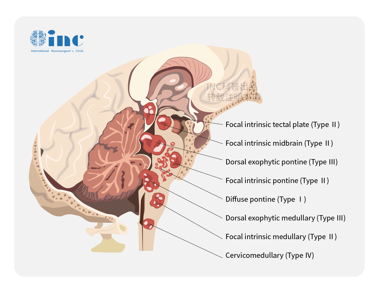 脑干胶质瘤有哪些分类？外生型