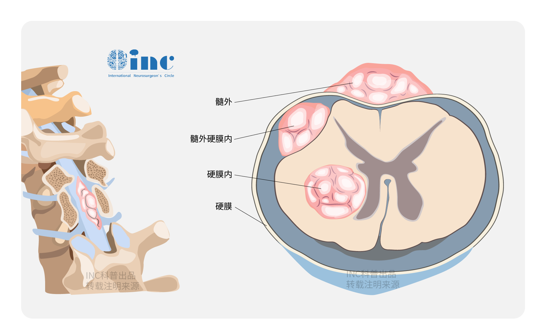 脊髓髓内肿瘤有那些？脊髓髓内