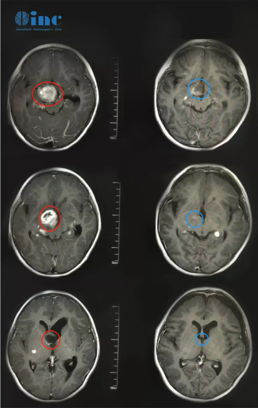 丘脑胶质瘤影像