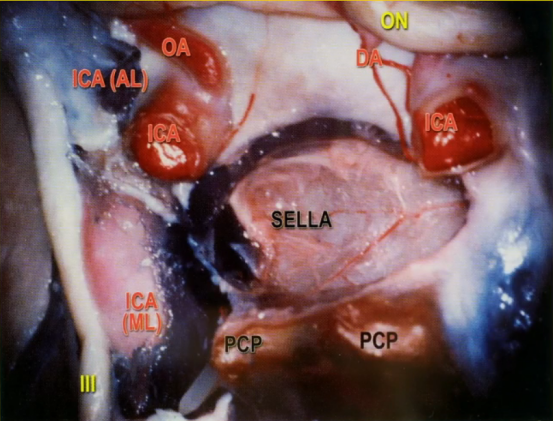 海绵窦区脑膜瘤会压迫哪些神经？海绵窦区脑膜瘤可以手术吗？