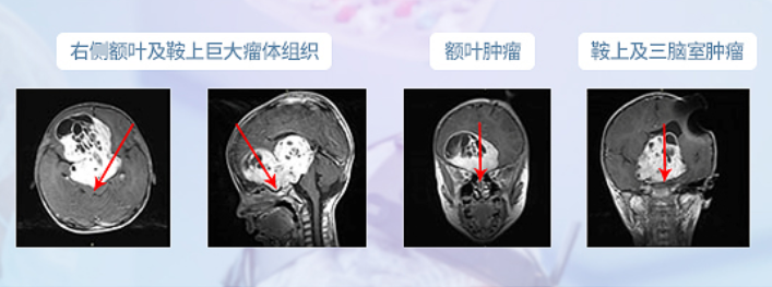 儿童视神经胶质瘤会失明吗？如何治疗视神经胶质瘤保留视力？