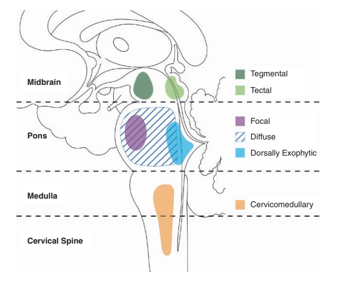 脑干胶质瘤长在延髓颈髓有哪些症状？脑干延髓-颈髓胶质瘤预后怎么样？