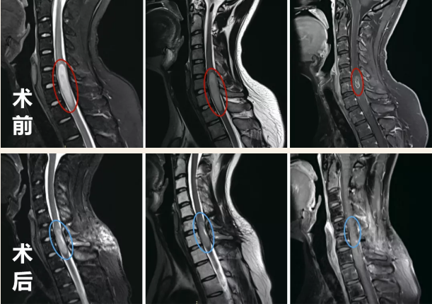 脊髓髓内常见的肿瘤有哪些？脊