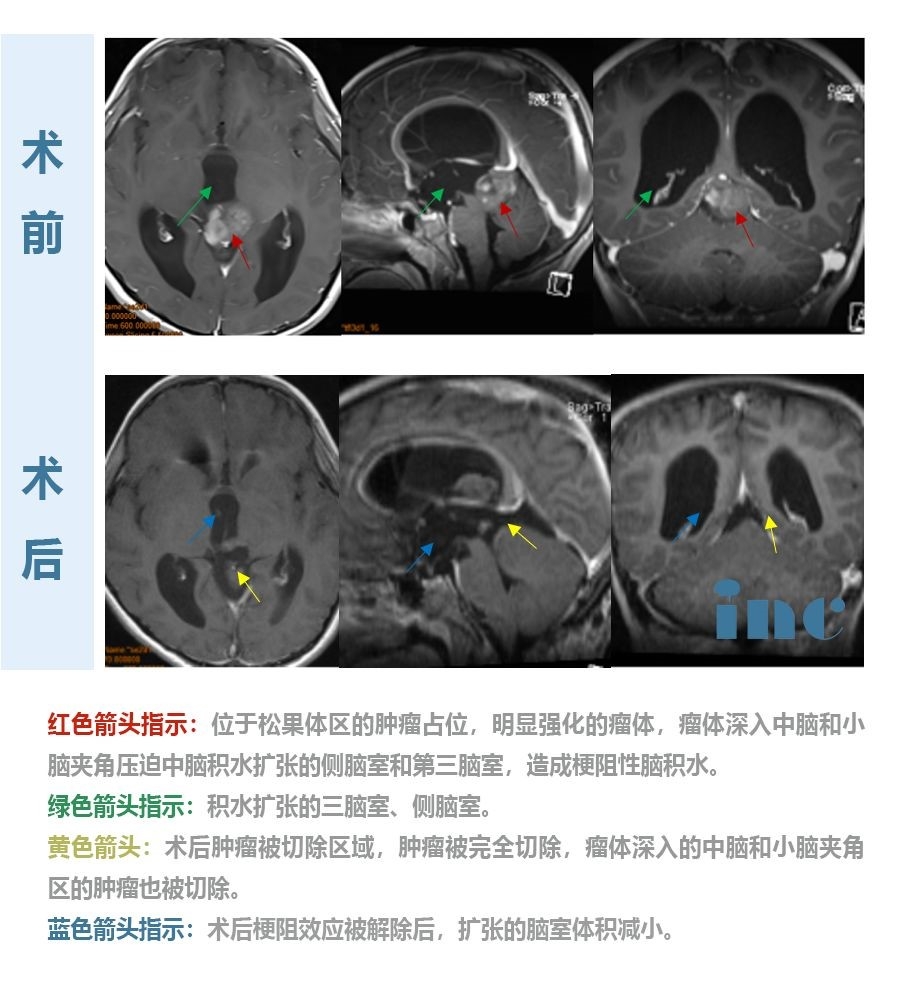 松果体细胞瘤的临床表现有哪些？如何治疗？INC巴特朗菲教授治疗案例分享