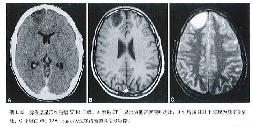 弥漫性星形细胞瘤能治好吗？弥漫性星形细胞瘤手术后能活多久？