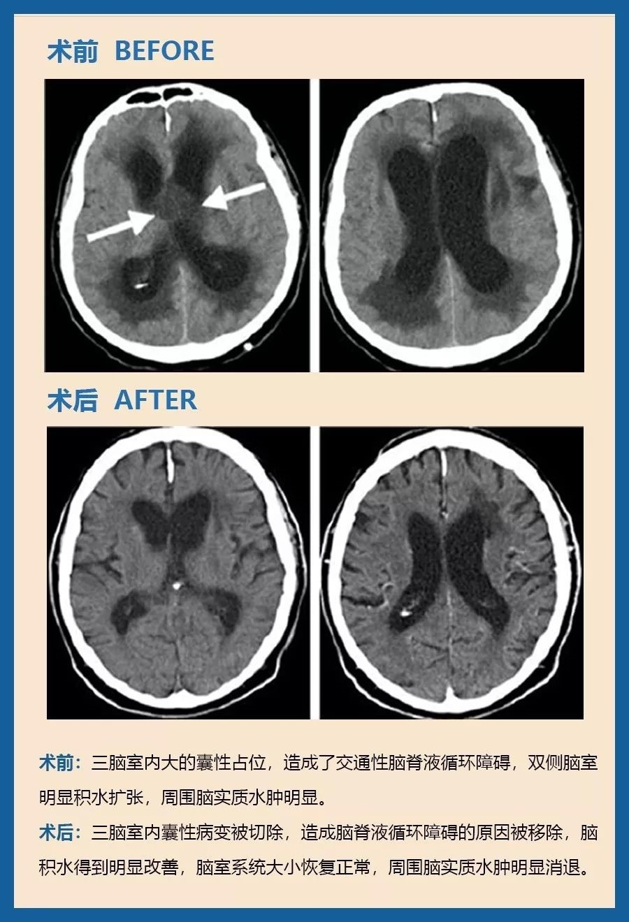 颅咽管瘤有什么危害？颅咽管瘤