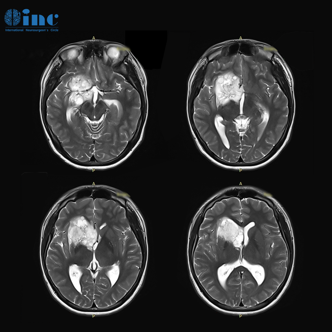 基底节胶质瘤案例