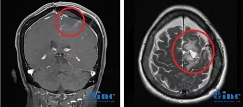 大脑镰旁脑膜瘤怎么治疗？图片