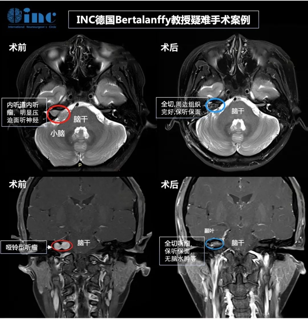 听神经瘤面瘫能恢复吗？术前术后