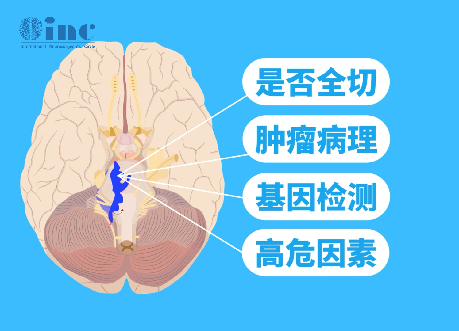 脑室外神经细胞瘤是什么病？脑室内神经细胞瘤症状、MRI、治疗简述