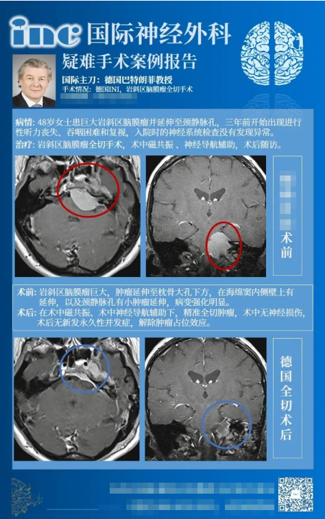 岩斜区脑膜瘤手术九死一瘫