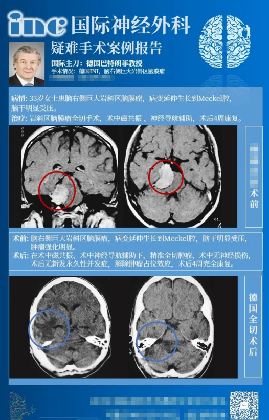 岩斜区脑膜瘤手术风险