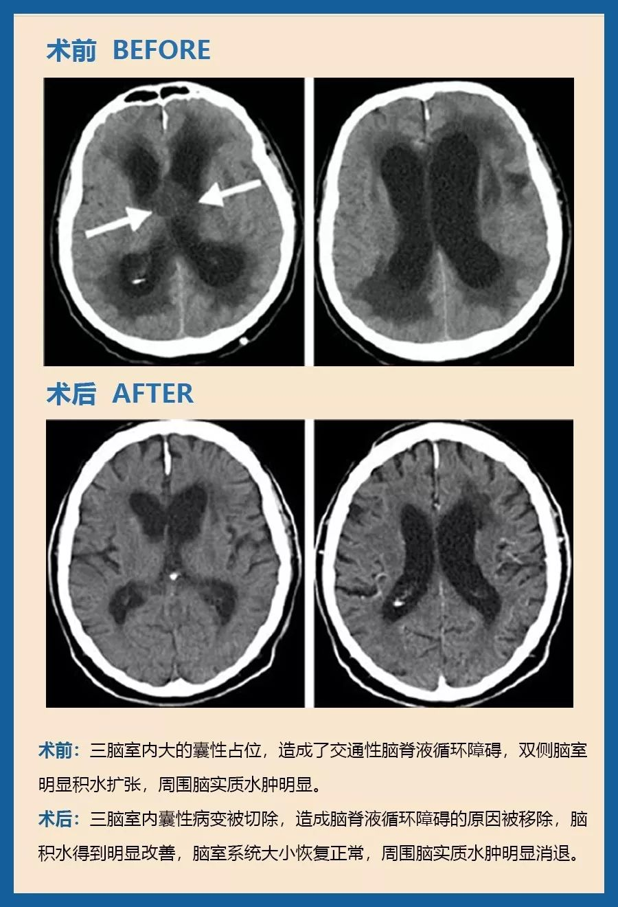 颅咽管瘤可以微创手术吗？