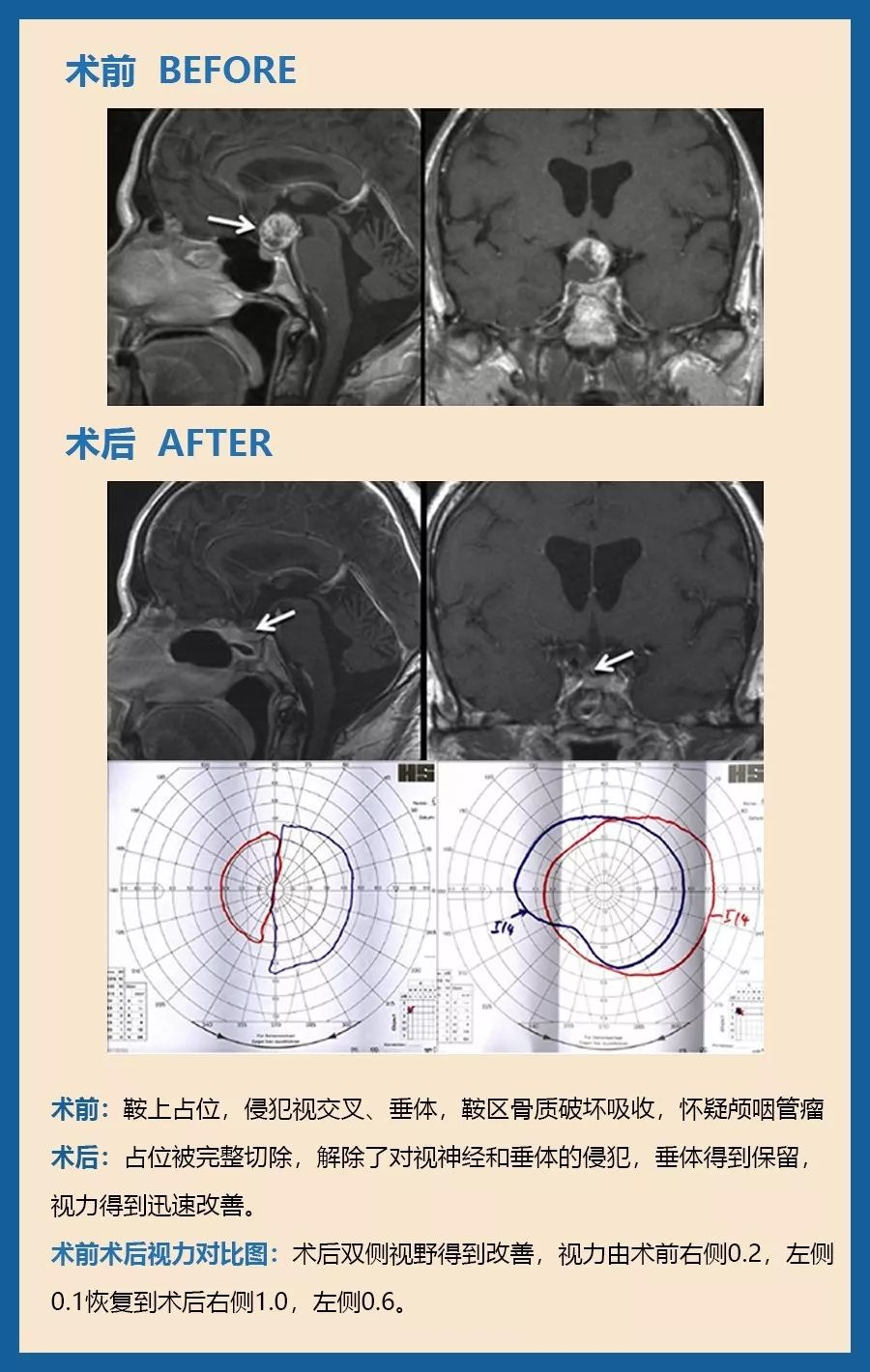 颅咽管瘤可以微创手术吗？图片