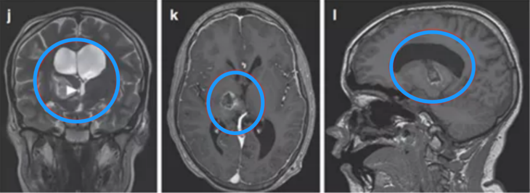丘脑胶质瘤的最佳治疗办法是哪种？图片