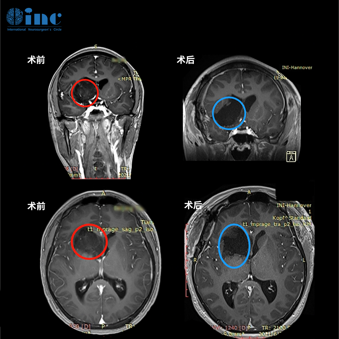 基底节胶质瘤术前术后