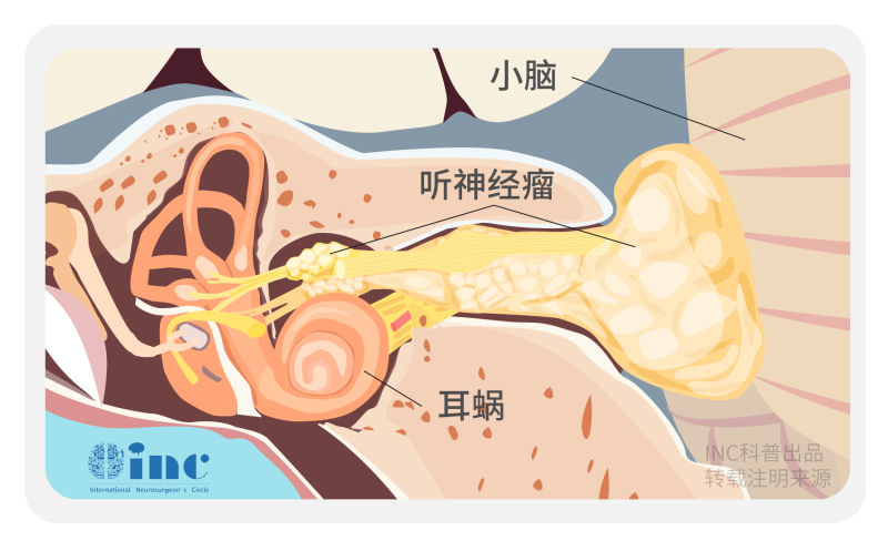 听神经瘤手术好还是放疗好？