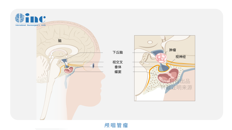 颅咽管瘤术后并发症有哪些？