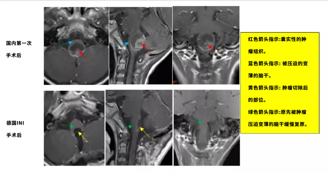 7岁男孩恶性脑干室管膜瘤，首刀