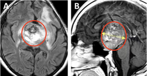 儿童丘脑浸润性胶质瘤:H3 K27M突变中线胶质瘤手术的作用