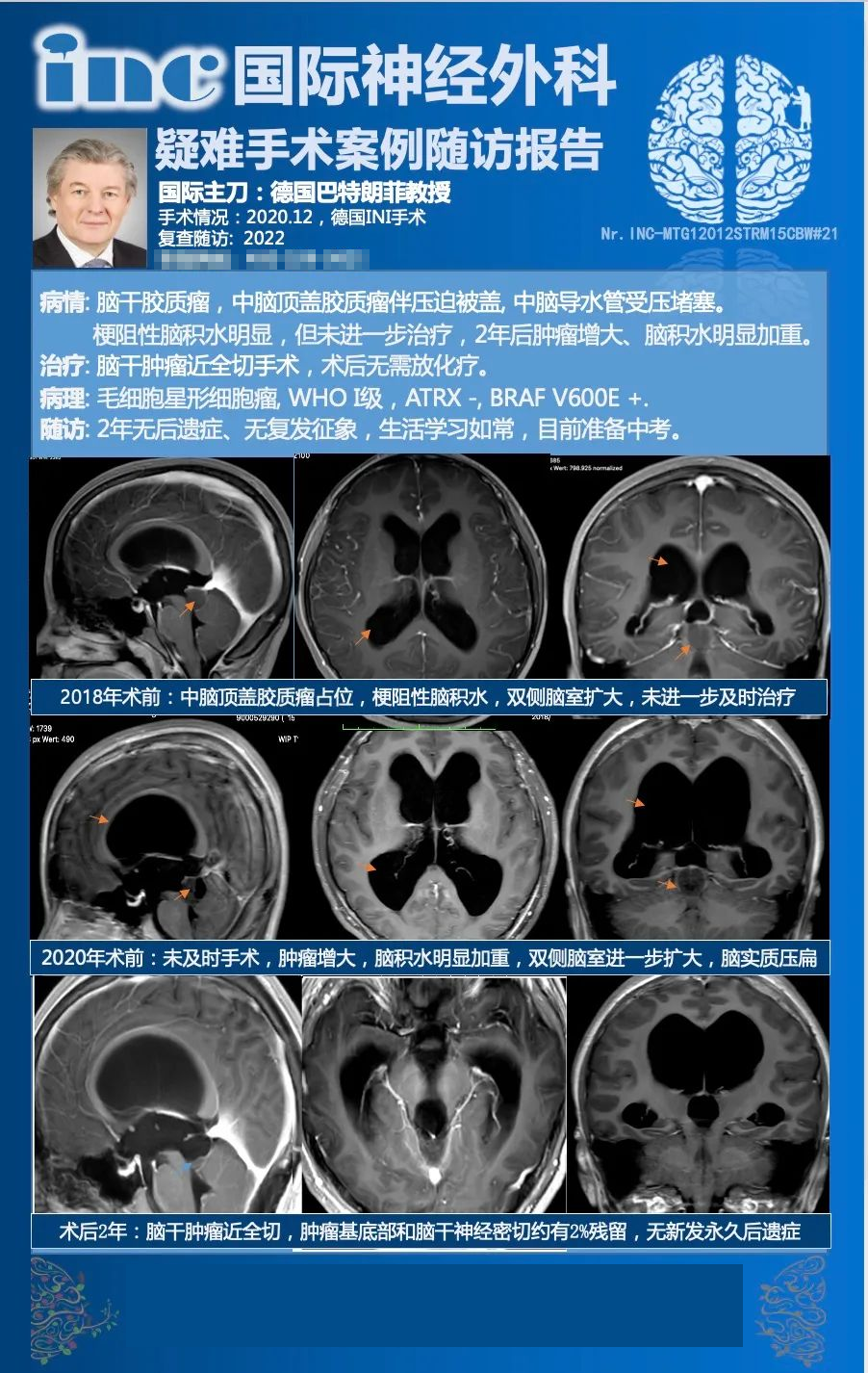 儿童毛细胞型星形细胞瘤如何治