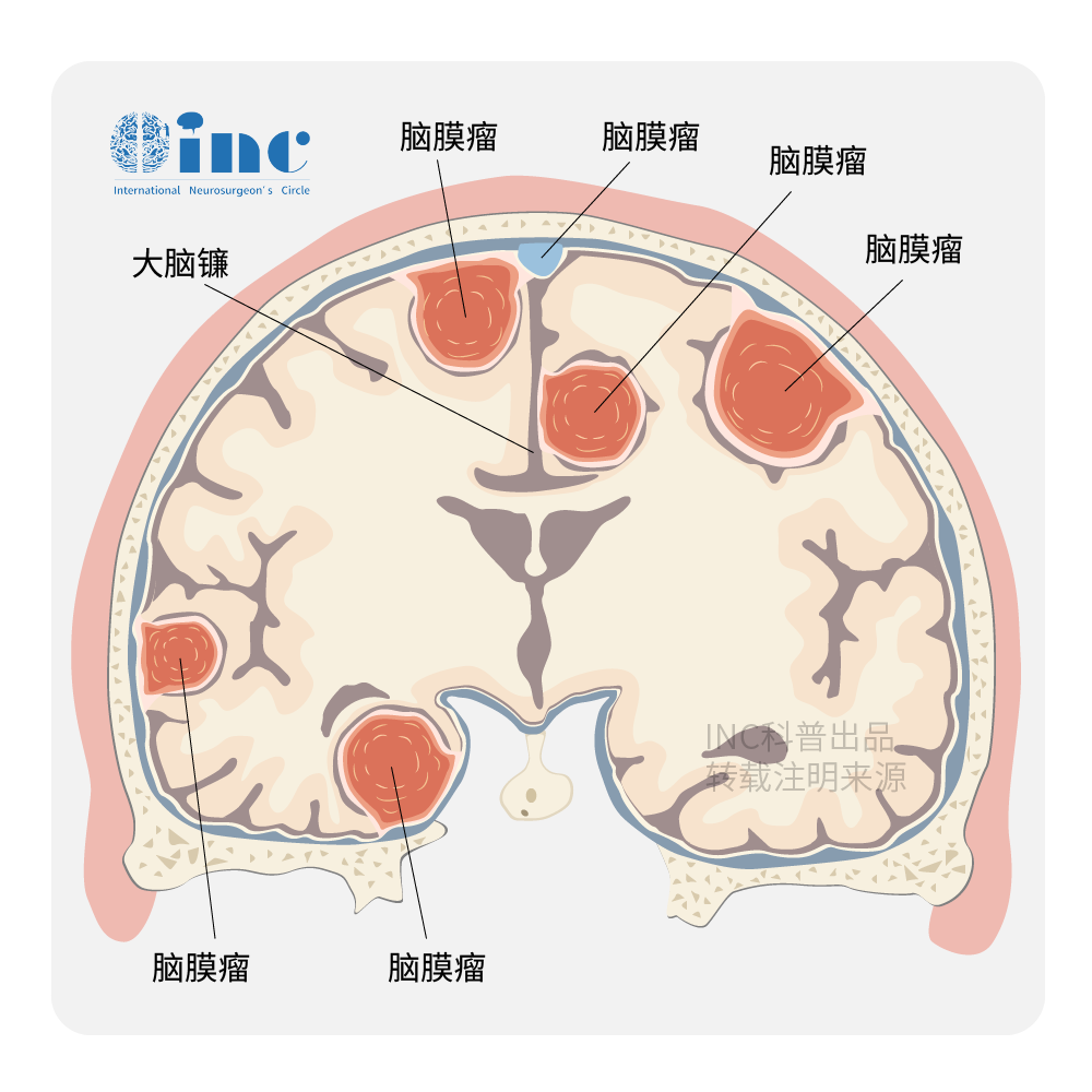 脑膜瘤手术难吗？