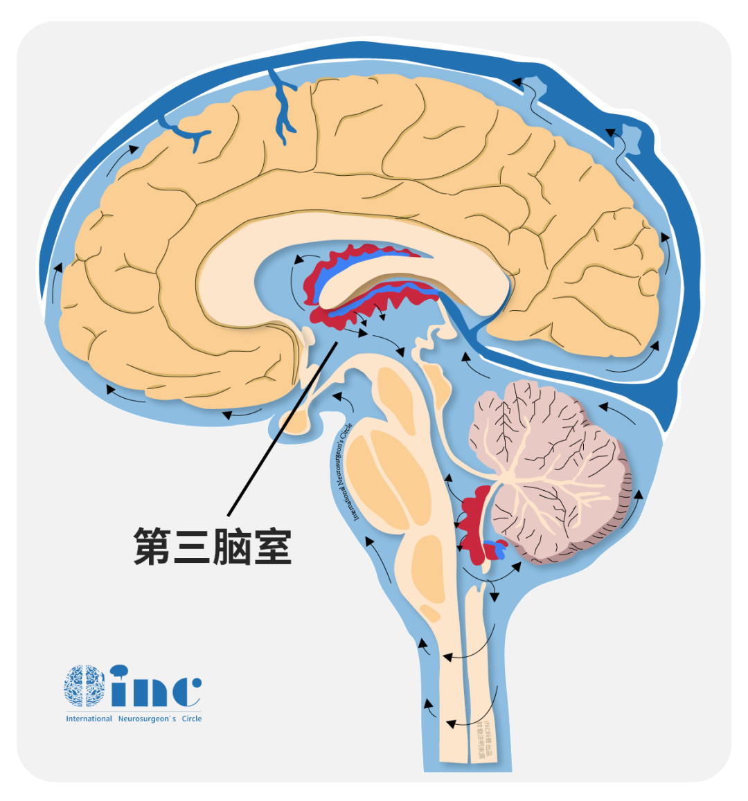 脑室海绵状血管瘤图片