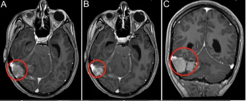 巨大恶性脑瘤案例
