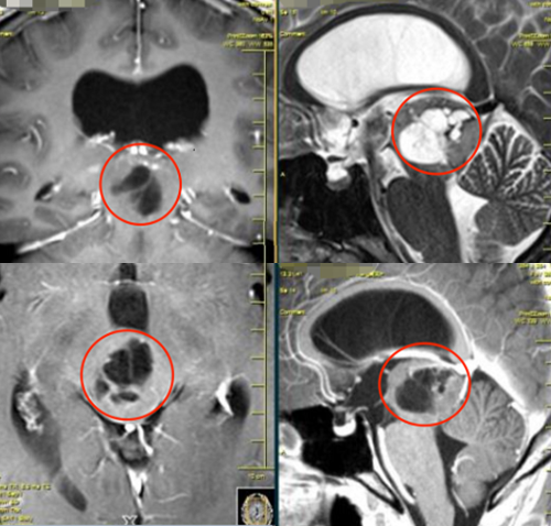 脑干胶质瘤有哪些类型？案例