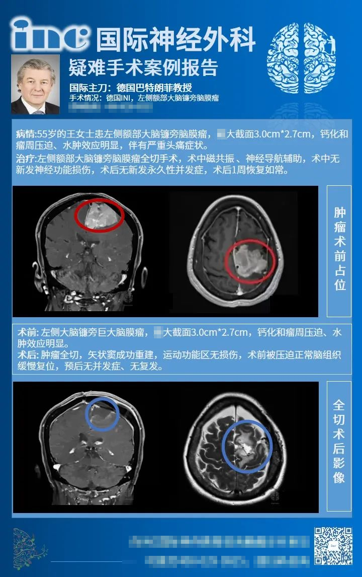 良性脑膜瘤不建议手术怎么办？案例