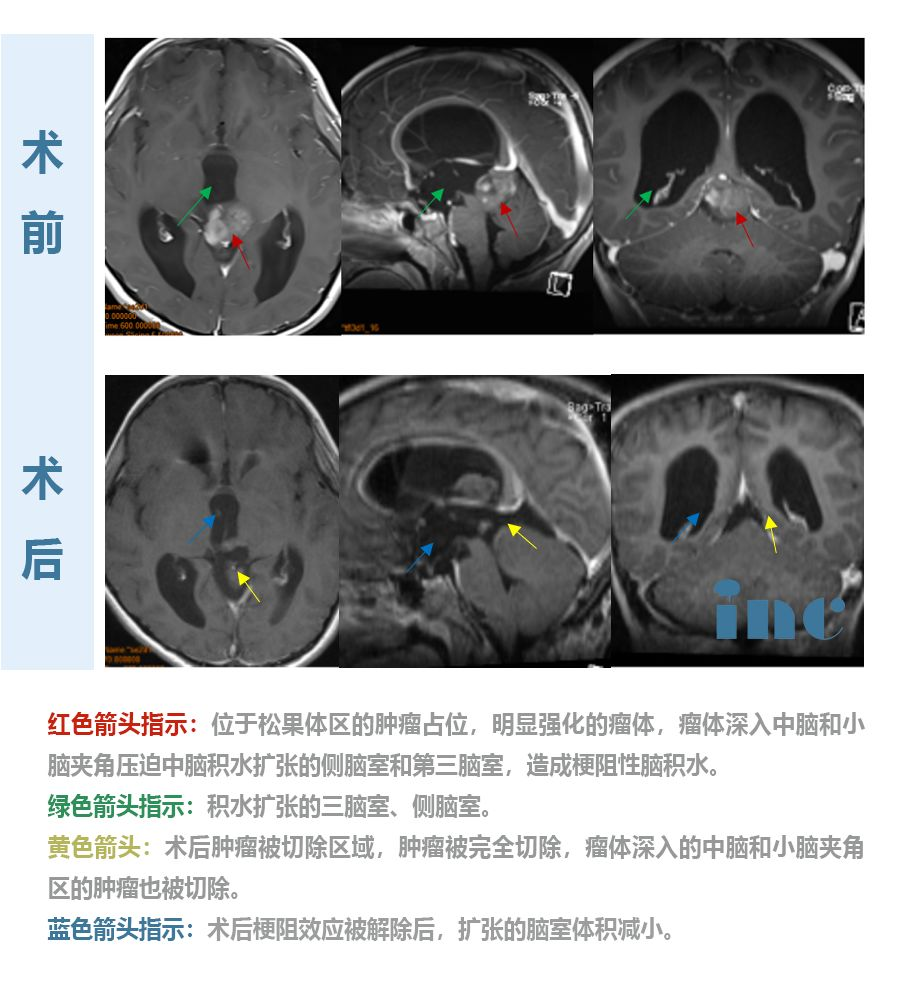 松果体区肿瘤手术后能治愈吗？