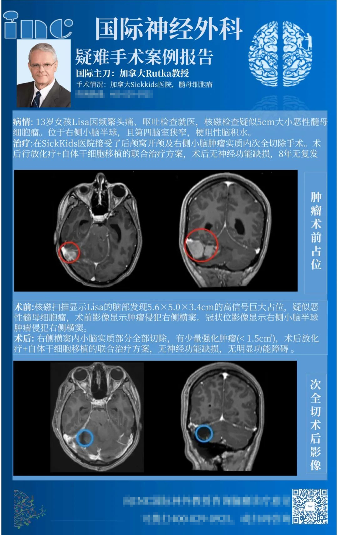 5cm巨大髓母细胞瘤能活多久？