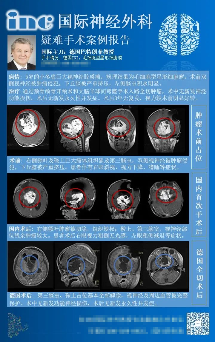 视神经胶质瘤放疗化疗可以消失吗？