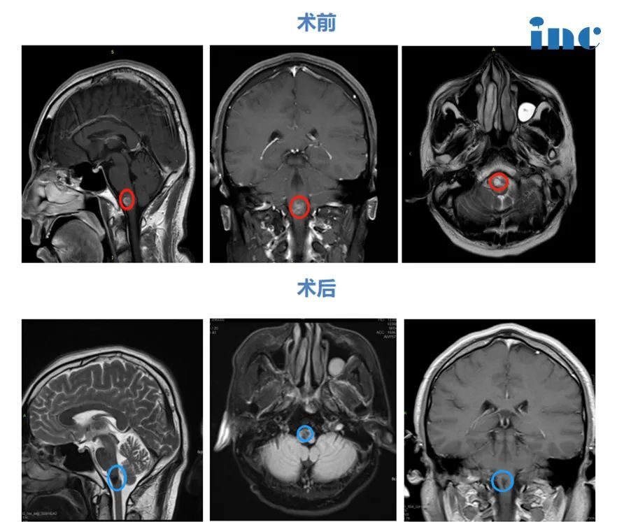 延髓海绵状血管瘤严重吗案例