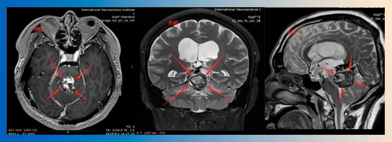 松果体区肿瘤手术案例