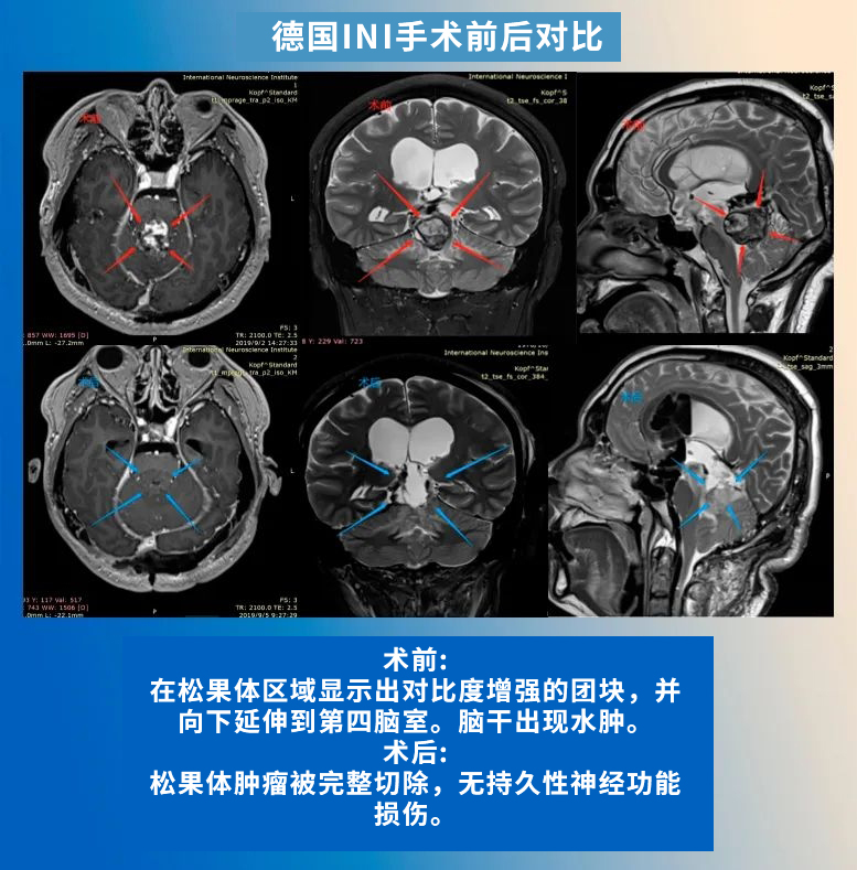 松果体区肿瘤手术案例对比