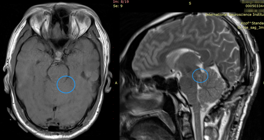 脑干胶质瘤影像