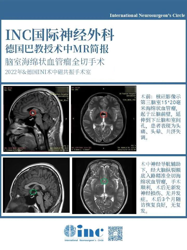 海绵状血管瘤怎么治