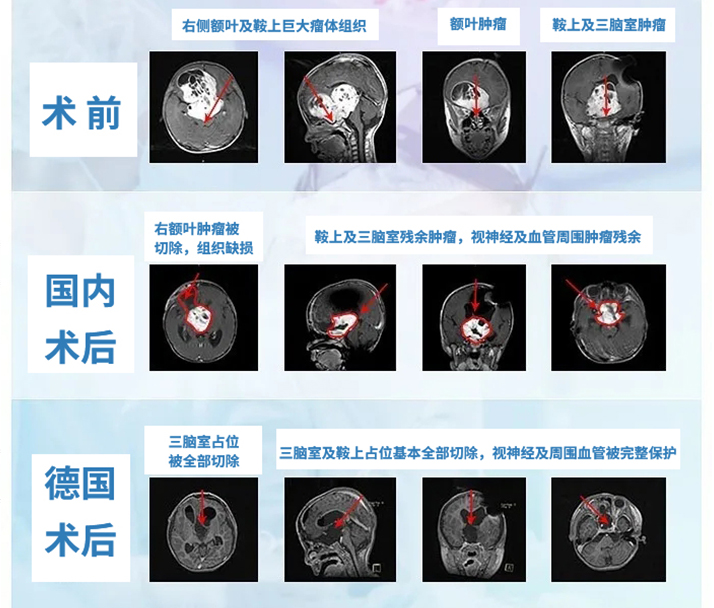 儿童视神经胶质瘤能治好吗？案例