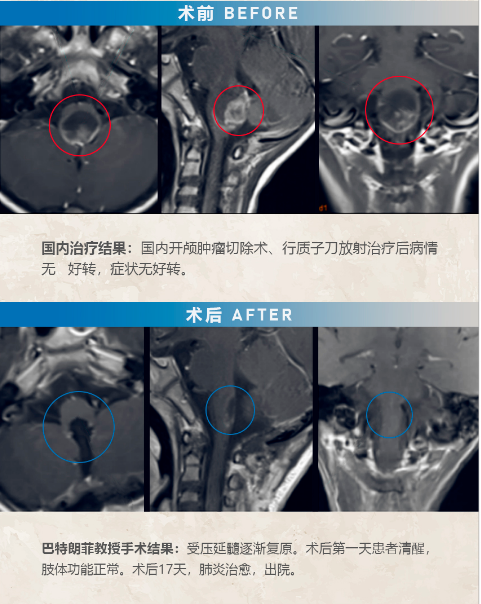 四脑室肿瘤手术