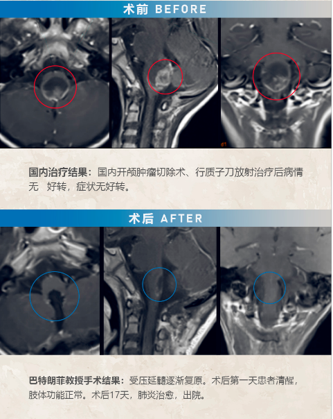 第四脑室肿瘤手术