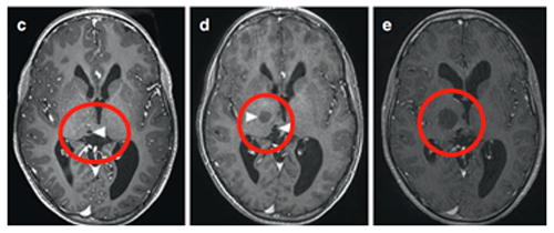 儿童丘脑胶质瘤怎么治疗？3岁患