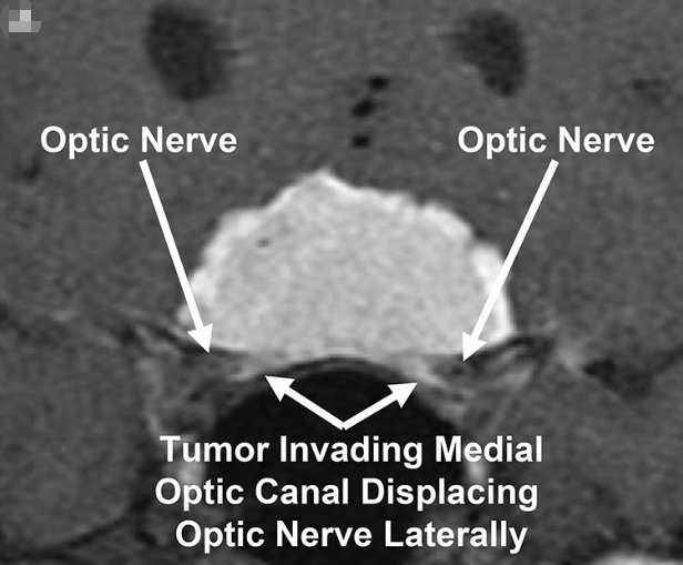 鞍结节脑膜瘤会影响视力吗？如何治疗才能保住视力？