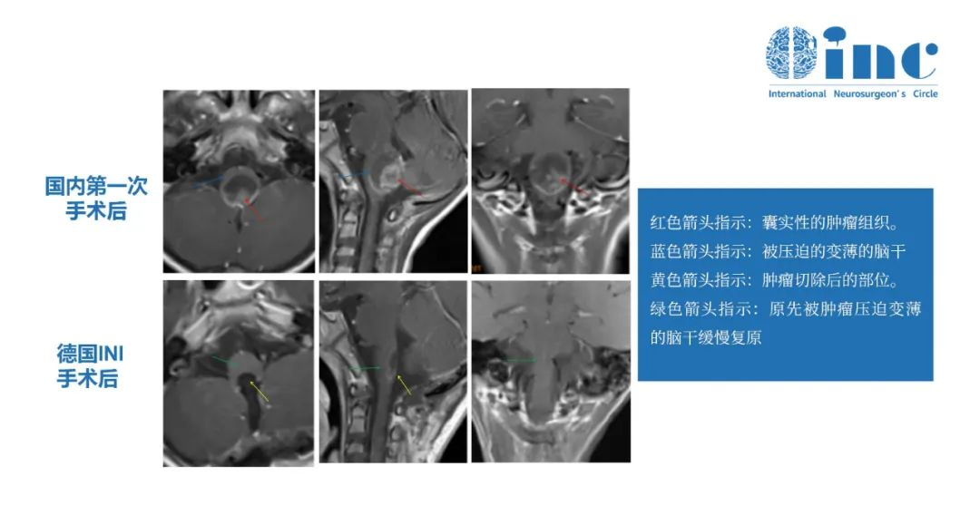 后颅窝室管膜瘤A型和B型如何区分？后颅窝室管膜瘤治疗患者案例分享