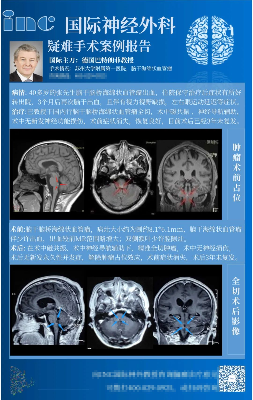 位于Monro孔的脑室内海绵状血管瘤有治愈可能吗？-INC国际神经外科医生集团