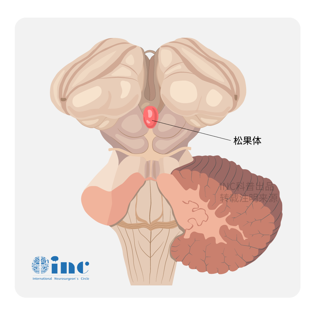 大脑深部松果体区肿瘤手术难度