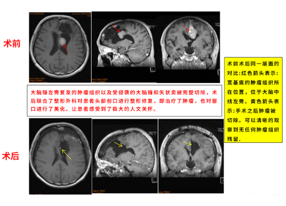 多发脑膜瘤治疗